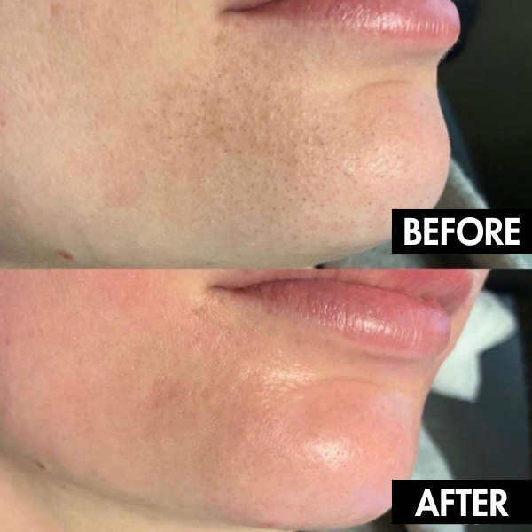 LumiSkin™ Electric Pore Vacuum